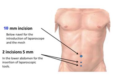 Laproscopic surgery Picture of Laproscopic surgery